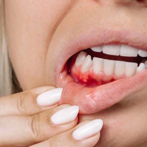 عفونت دندان چیست؟ بررسی علت بروز انواع عفونت دندان