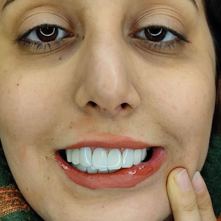 عکس بعد از کامپوزیت دندان