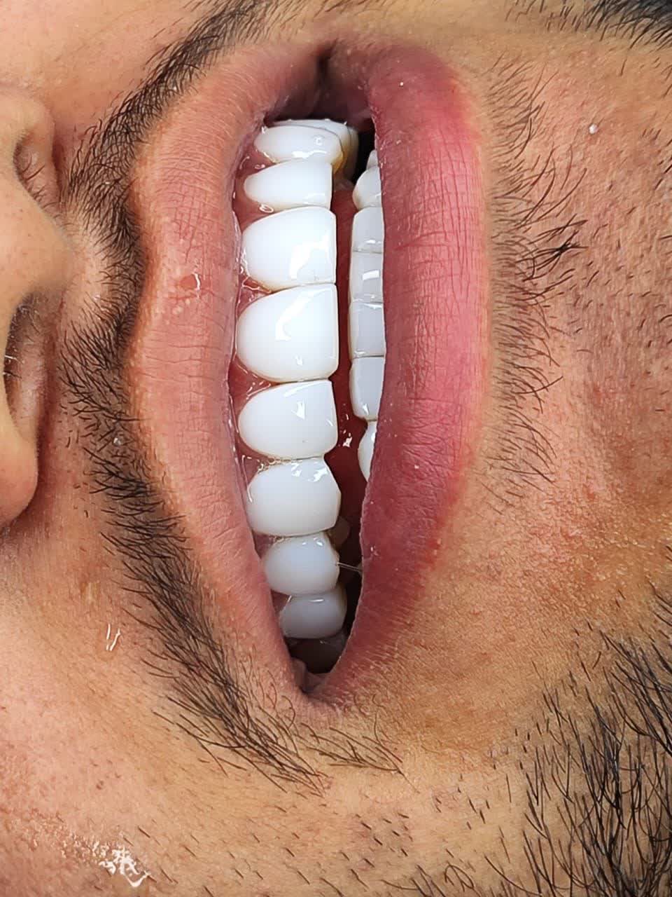 گالری تصاویر کامپوزیت دندان