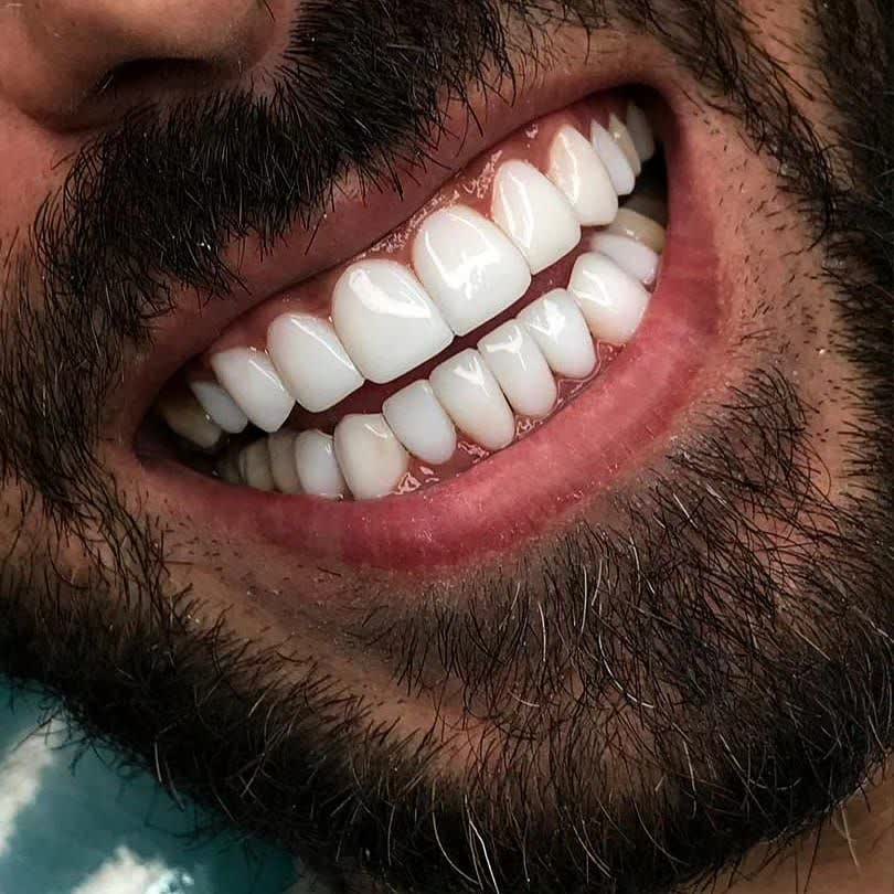 گالری تصاویر کامپوزیت دندان