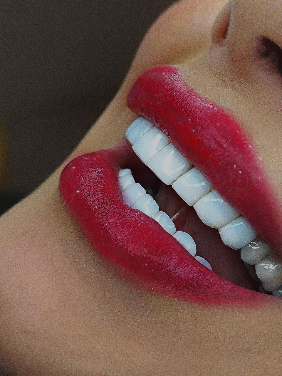 گالری کامپوزیت دندان